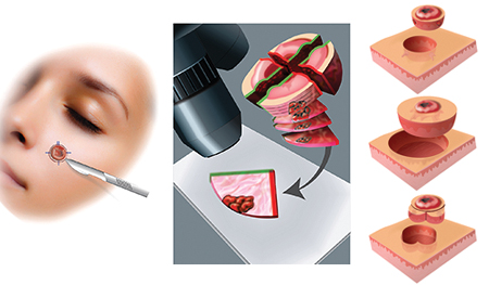 Full Color Illustrations for patient educational booklet
